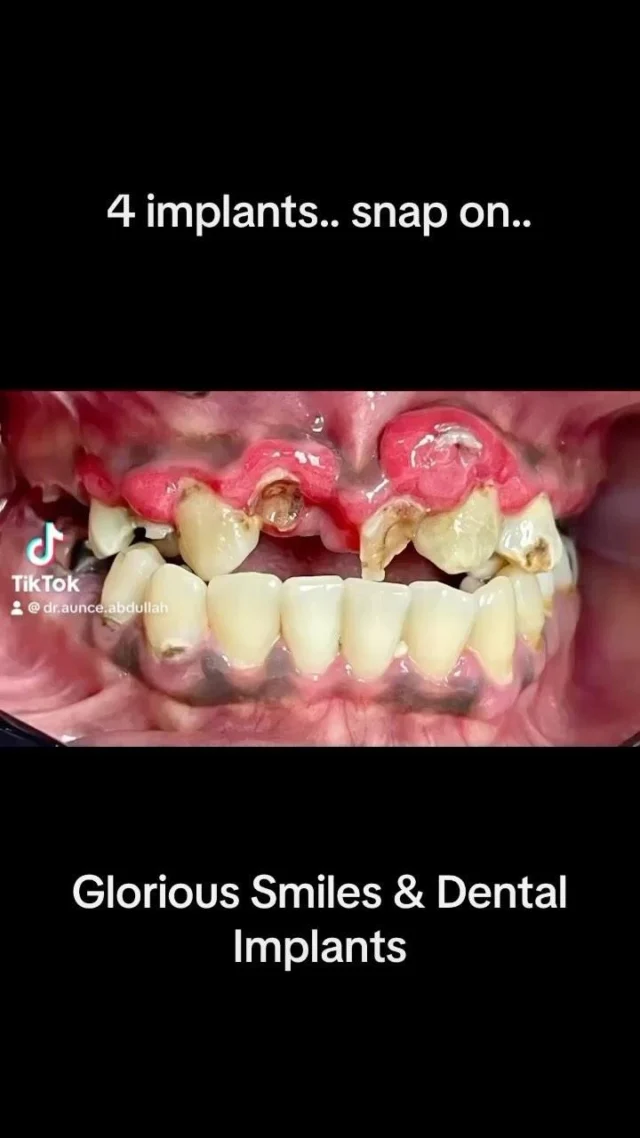 Full mouth reconstruction, all kind of services for our patients, improve your health your smile and quality of life
.
.
.
.
.
.
#dentalimplants #veneers_smile #dentureimplants #dentalcrowns #fullmouthrehabilitation #invisaling #rootcanaltreatment
Book your appointment from website on profile