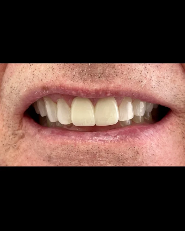 Anterior crowns replacement, our wonderful patient is so happy about it #dentalcrowns #dentalestheticdesign #dentalcosmetics #dentalhealth