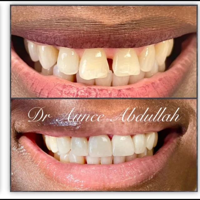 Porcelain veneers can be used to improve your smile and can transform the appearance of your teeth in just one visit. 

Call us now: 713-228-3384. We are located at 5901 Westheimer Rd, Suite D, Houston, TX 77057

#houstonveneers #houstondentist #houstondental #houstoncosmeticdentist