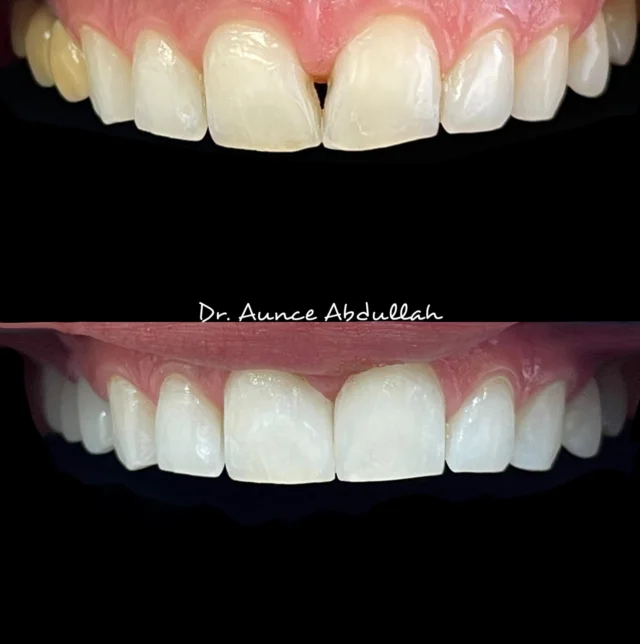 Upper Right bridge zirconia... Anterior composite... zoom whitening @glorious.smiles.dental  #dentalart #dentalbridge #cosmetıcdentıstry #teethwhitening #zoomwhitening #dentalcomposite