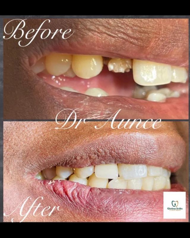 Your smile can still be saved ! Dental crowns are tooth-shaped
“caps” that can be placed over your tooth, covering the tooth to restore its shape and size, strength, and or to improve its appearance.
A dental crown is a very effective treatment used to restore a tooth that has been damaged in some way
It provide an adequate solution to a range of dental problems.
#houstondental #houstondentistry #houstondentist #galleriadentaloffice #uptowndental #htxdentist #houstondentalclinic #crowns #houstonimplant