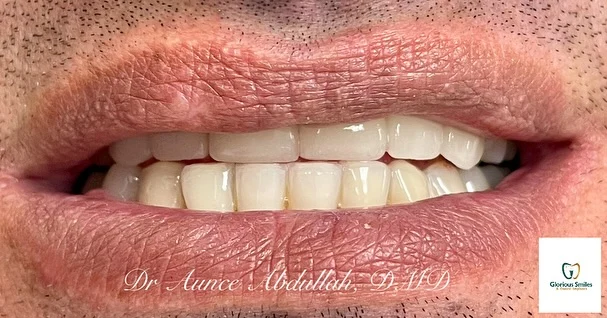 Dental bridges are excellent when Implants are not an option ✨🦷
#whitening #dentalbridges #dentalveneers #dentalimplants #invisalign #dentisthoustontx 
.
.
.
.
Tel (713)228-3384