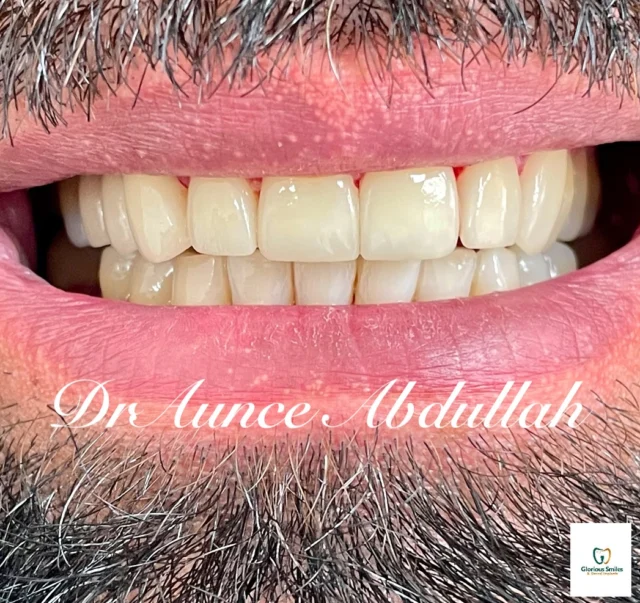 All I want for Christmas is a beautiful Smile 😃#teethveneer #teethwhitening 🦷✨
