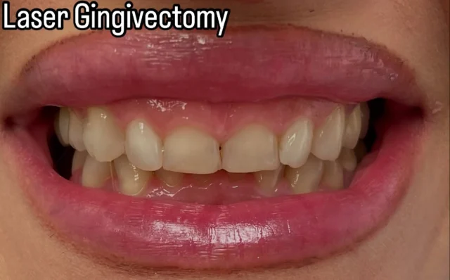 Gingivectomy using LANAP LASER ..
#gingivectomy #smile😊 #dentalveneers #teethwhitening #dentalimplantsurgery #dentalcrowns #invisalign
