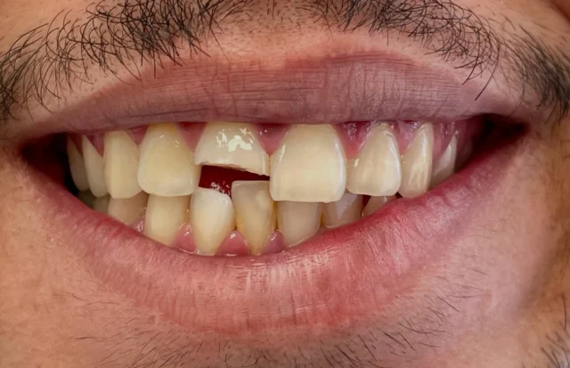 Emergency treatment Dental crown 🌟

#dentalcrowns #teethwhitening #dentalimplant #invisalign #dentalveneers #dentalhygiene #dentalcleaning