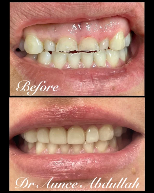 4 anterior  veneers and it made huge difference 😍