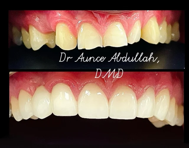You'll find that life still worthwhile if you just smile 😃 
#dentalveneers #dentaldesign #dentalimplant #teethwhiting #dentalbridges #dentalcrown #invisalign