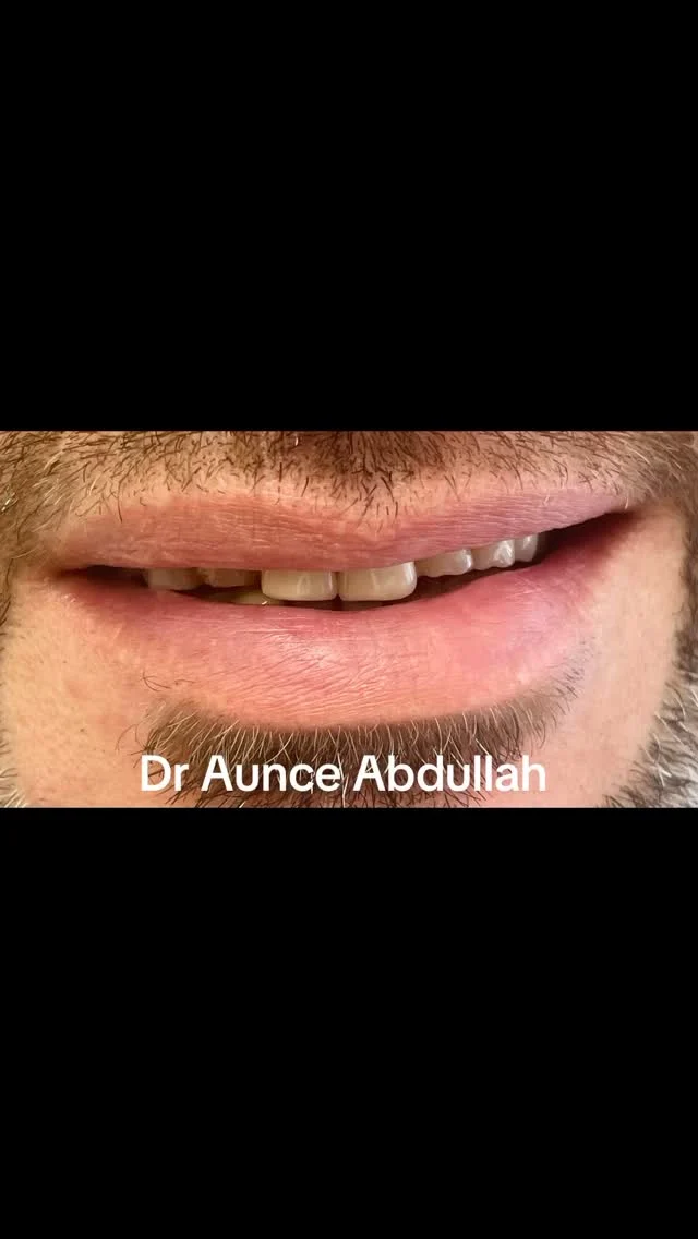#invisalign #teethwhitening #dentalcrowns #dentalimplants #dentalbridges #dentalveneers #houstondentist